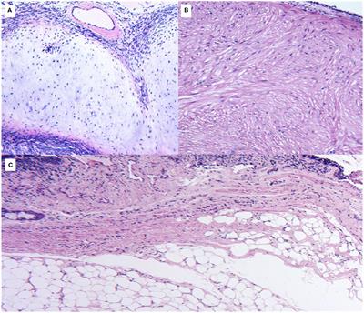 Benign Endobronchial Tumors: A Clinicopathologic Review